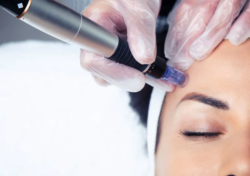 Close-up of a professional microneedling treatment