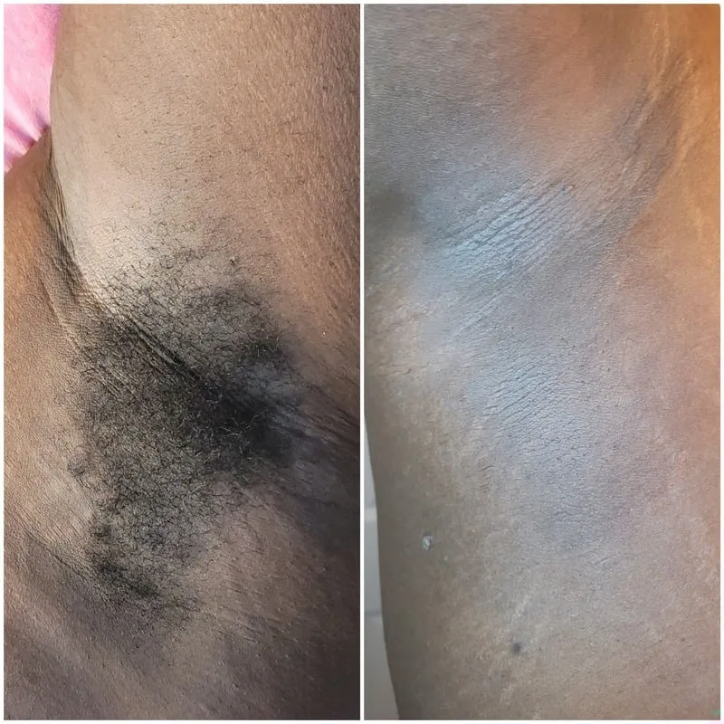 Before-and-after view of underarm waxing results